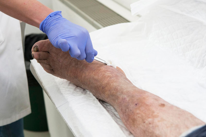 Peripheral Arterial Disease (PAD): Symptoms, Causes & Early Warning Signs